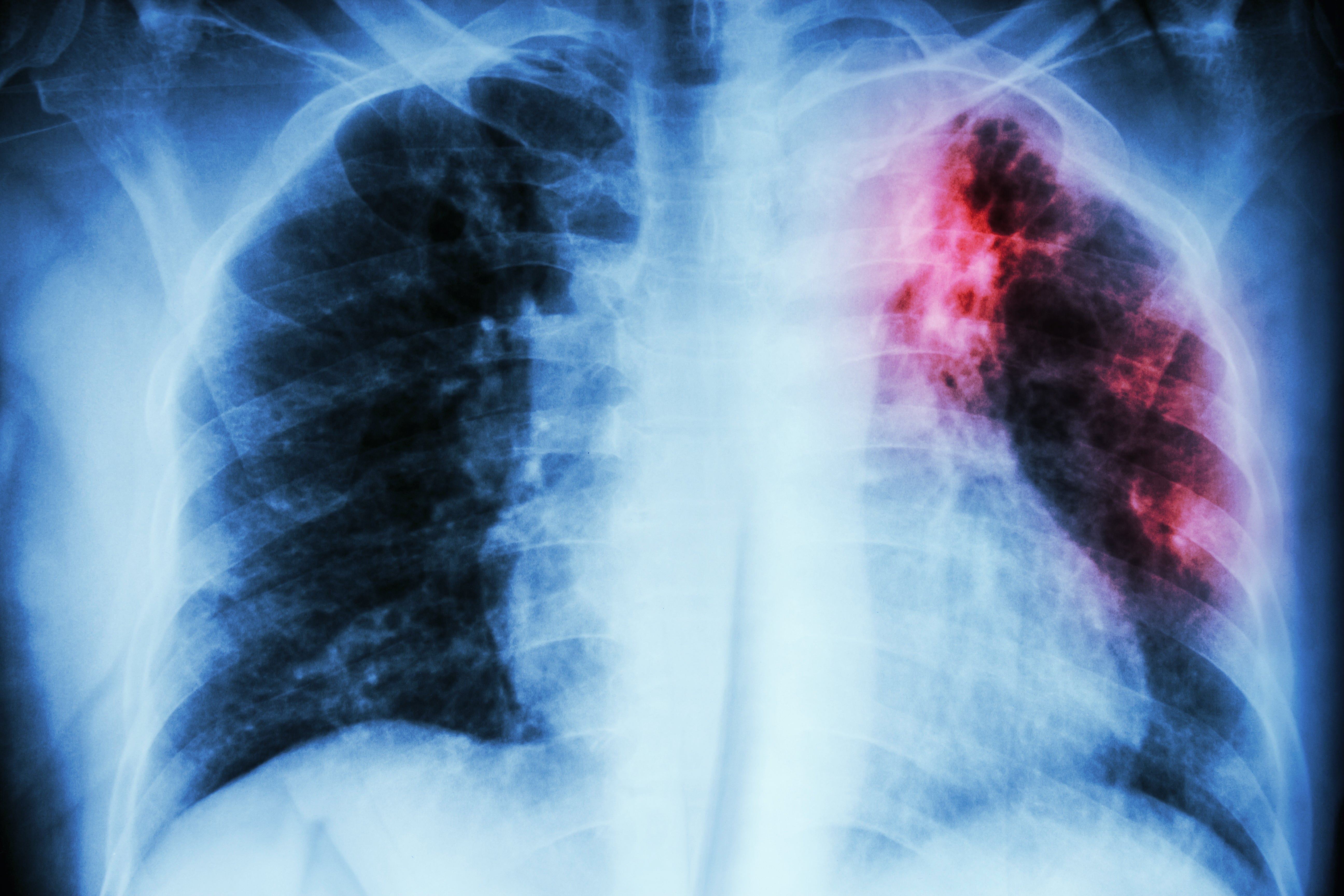 Tuberculosis (TB) has an R0 ranging from less than one and up to four
